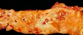 Reversing atherosclerosis facts