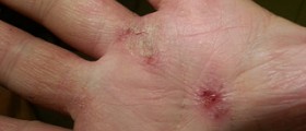 Atopic dermatitis symptoms