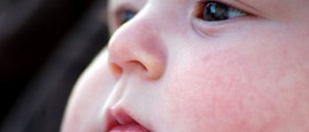 Acid reflux in babies