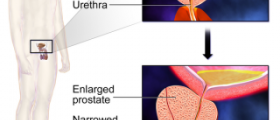 Benign prostatic hyperplasia BPH
