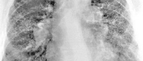 Symptoms of chronic beryllium disease