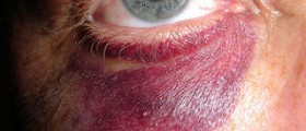 Black eye treatment cream