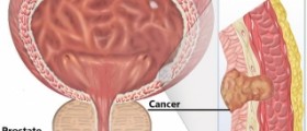 Bladder cancer survival rates