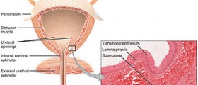 Interstitial Cystitis, Endometriosis's Evil Twin Brother