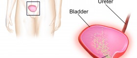 What causes bladder infections