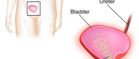Recurring bladder infections