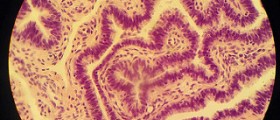 Blocked fallopian tubes - treatment