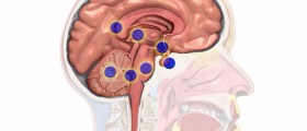 Brain cancer symptoms