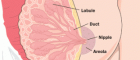Breast duct ectasia