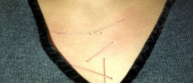 Cracked sternum review