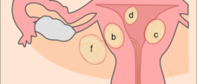 Can you conceive naturally with uterine fibroids?