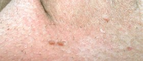 Can you still get genital warts if you use condoms?