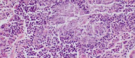 Chronic mucocutaneous candidiasis