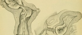Retained placenta treatment options