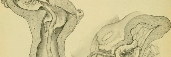 Retained placenta treatment options