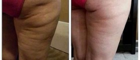Effective reduction of cellulite