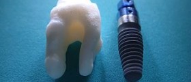 Dental implants facts