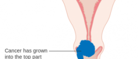 Therapy for cervical cancer