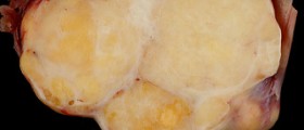 Benign cervical tumor