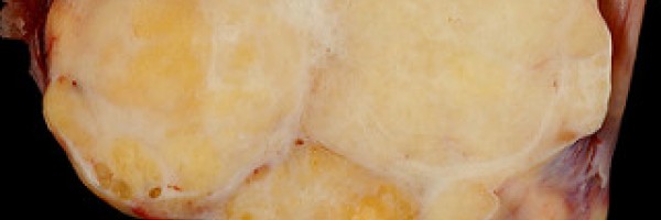 Benign cervical tumor