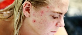 Chemical peels for acne scars