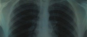 Chest congestion causes
