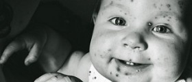 Skin rashes in children