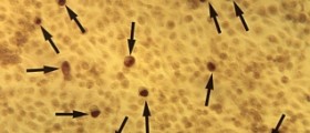 Tubal pregnancy as a result of chlamydia