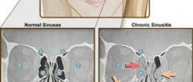 Prevention of sinusitis