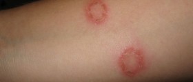 Circular red rash