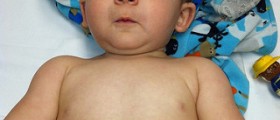 Croup in babies