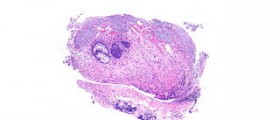 Reduce cystitis severity