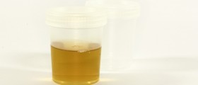 Dark Urine: What Could Be Wrong With You If Your Pee Is Brown Or Black?