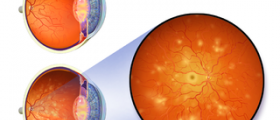 Nonproliferative diabetic retinopathy