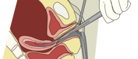 Getting pregnant after miscarriage and D&C