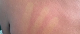 Rash with fever