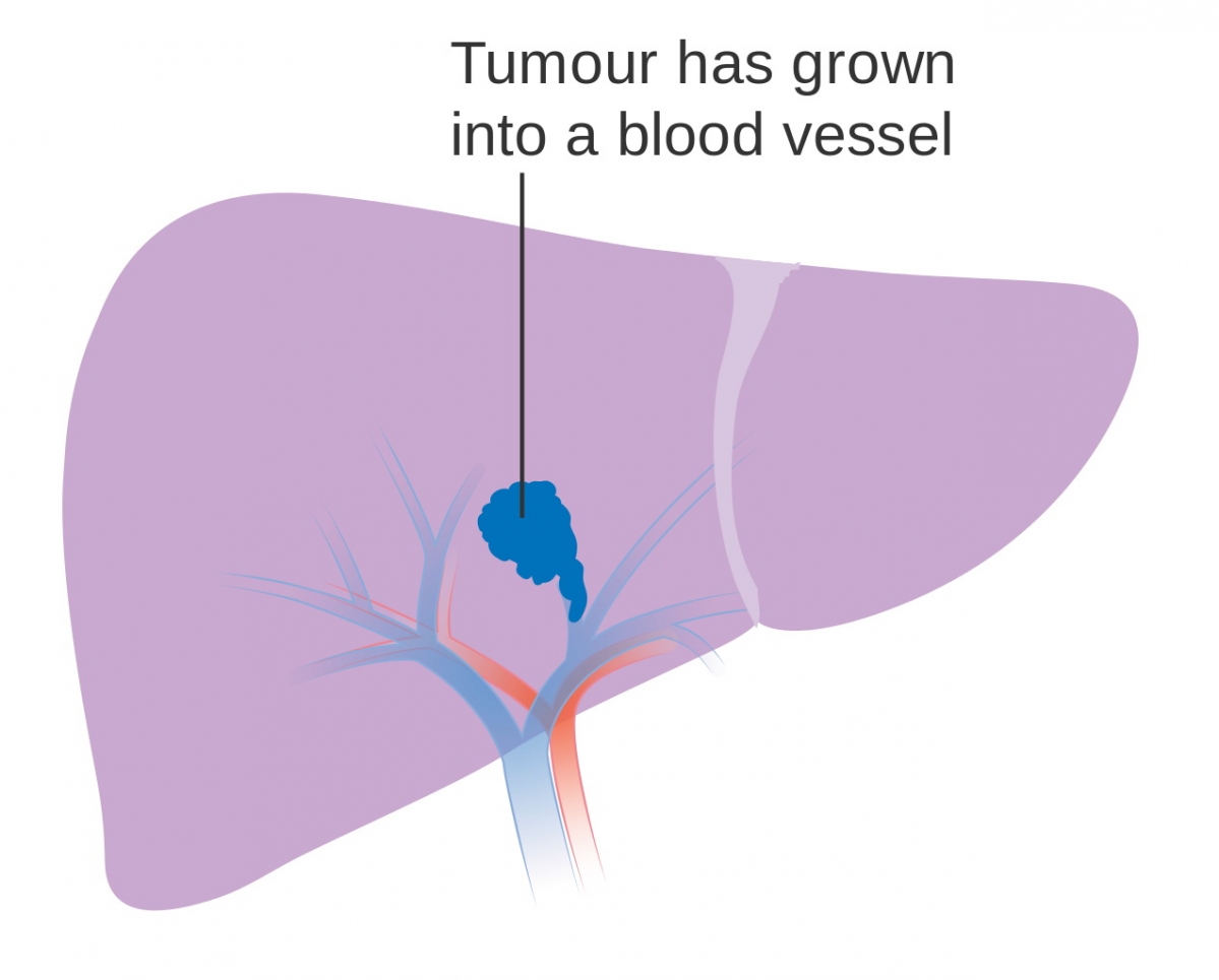 Liver cancer a silent killer Cancer articles Body