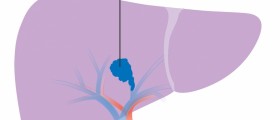 Liver cancer - a silent killer
