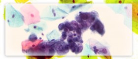 Easy ways to prevent genital herpes