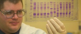What is Edwards Syndrome?