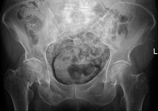 cystitis chronic symptoms steadyhealth