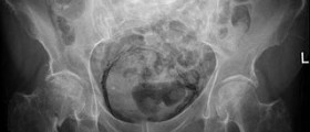 Chronic cystitis symptoms