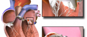 Prevention of endocarditis