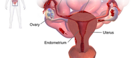 Is it possible to get pregnant naturally with endometriosis?