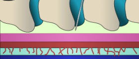 Can you walk around with an epidural in labor?