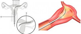 Essure tubal ligation