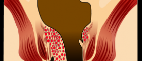 External hemorrhoids facts