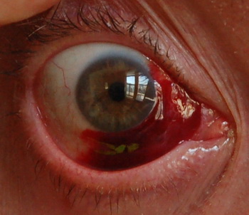 Causes of broken capillaries | General center | SteadyHealth.com