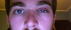 Eye stye home remedies