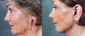 Face lift versus non-surgical face lift: which is best?